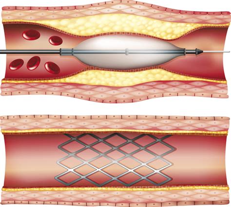 koronarangiographie stent